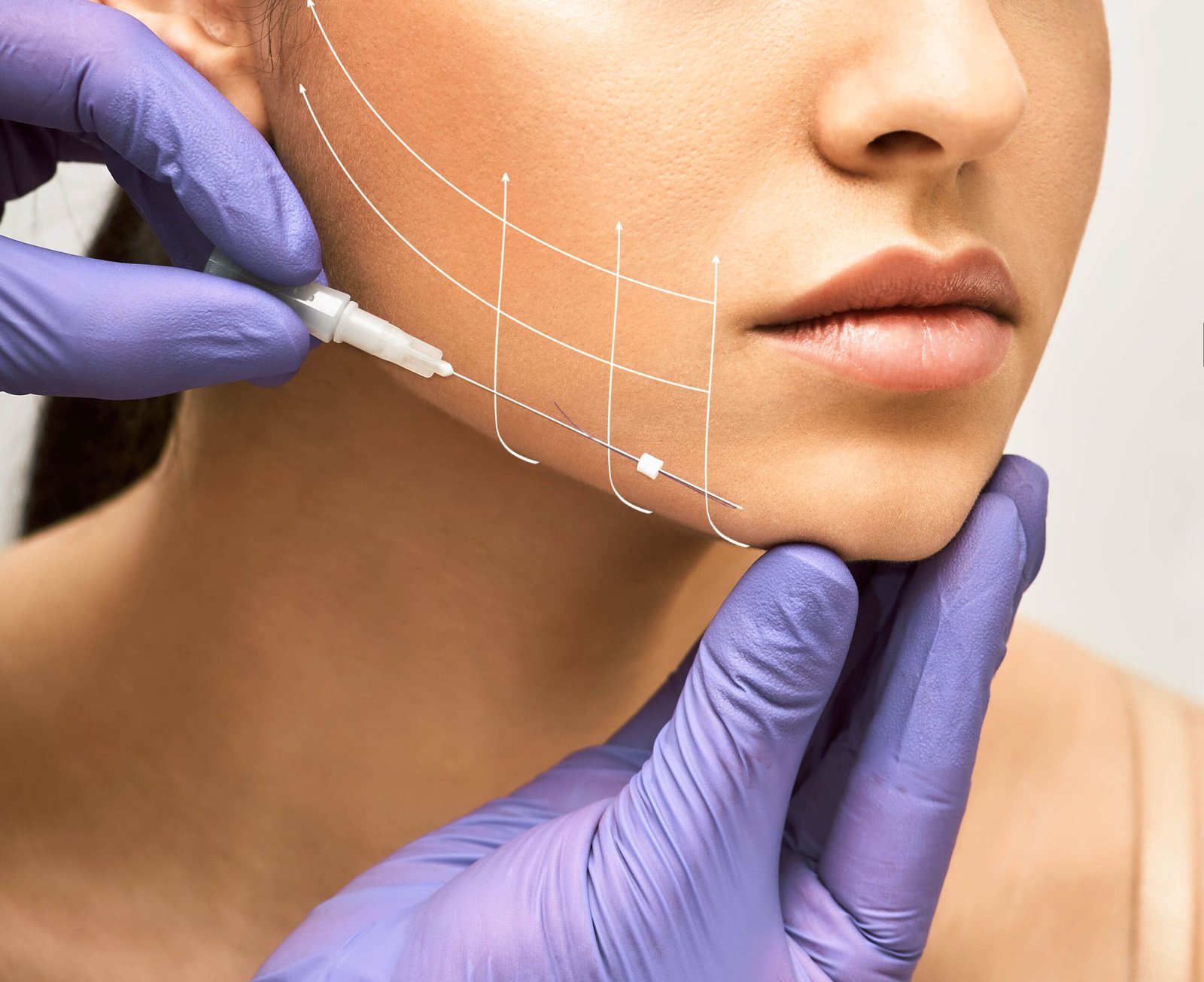 Facial lifting thread. Thread facelift with arrows on face for woman's skin, procedure facial contouring using mesothreads